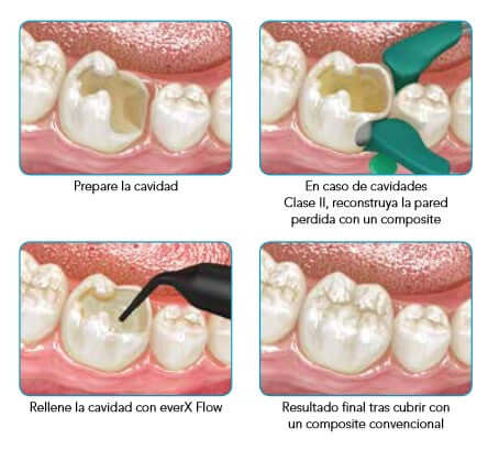 EverX Flow - Composite Bulk - fill Reforzado - GC - Odontologicos