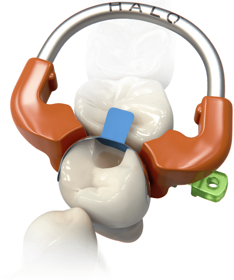 Matrices seccionales HALO - Ultradent - Odontologicos