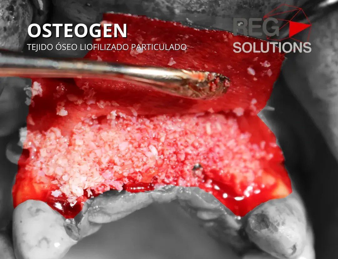 OsteoGen - Tejido óseo liofilizado Granulado - REG SOLUTIONS - Odontologicos