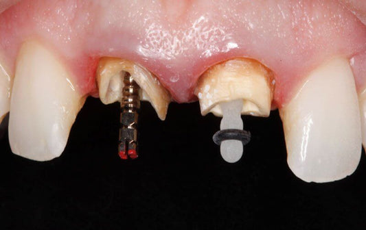 Para qué sirven los postes dentales en odontología - Odontologicos