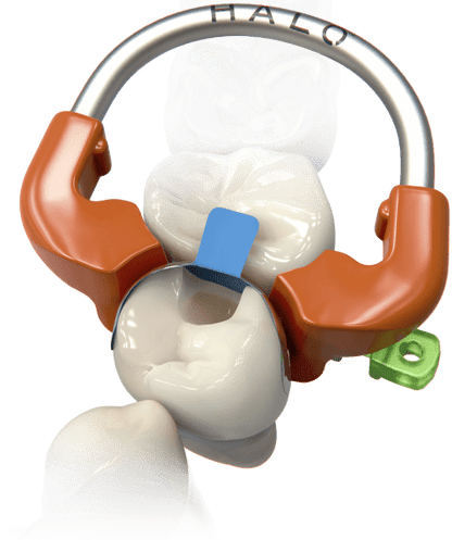 Matrices seccionales HALO - Ultradent - Odontologicos